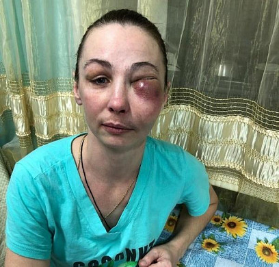  Многодетную маму из Иванова лечили от гайморита, а у неё оказалась лимфома 