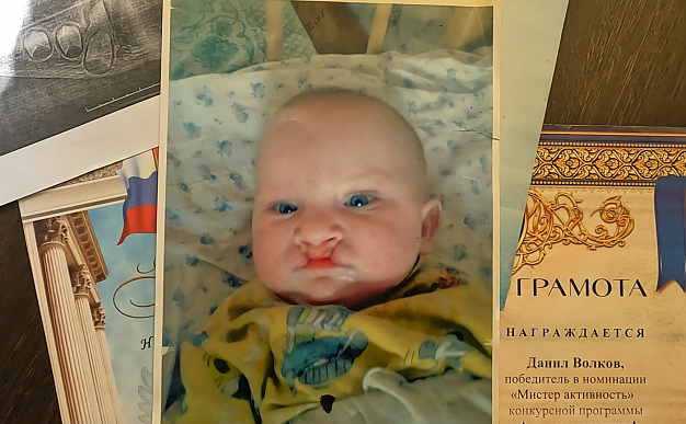Ребенку с «волчьей пастью» из Фурманова нужна помощь