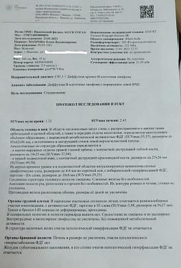  Многодетную маму из Иванова лечили от гайморита, а у неё оказалась лимфома 