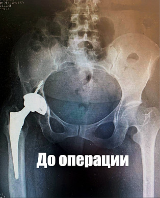 В Иванове провели высокотехнологичную операцию уровня федеральных медцентров 