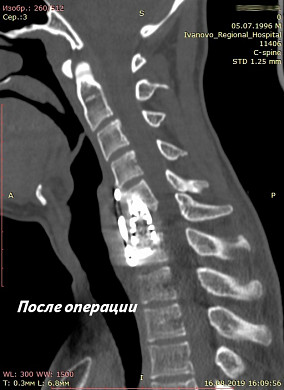  В Ивановской области за год 20 ныряльщиков сломали позвоночник 