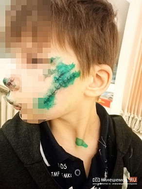 В Кинешме будут судить хозяина собаки, напавшей на ребенка