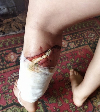 В Ивановской области кавказская овчарка едва не откусила женщине ногу