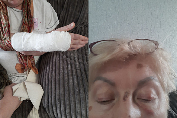 Ивановка сломала руку и разбила лицо при проходе через крытый переход у бывшего здания МВД